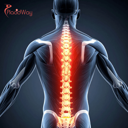 Spinal Fusion Surgery in Colombia: High-Quality Orthopedic Care for U.S. Patients at Lower Costs